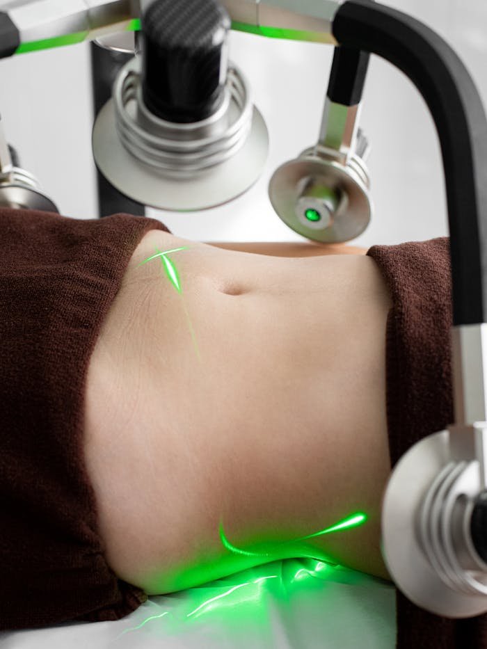 who-we-are Close-up of a woman's abdomen during a laser liposuction treatment in a medical facility.